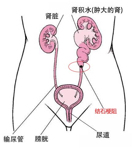 肾积水是怎么形成的？(图1)