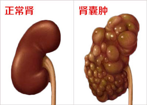 形成肾囊肿的原因有哪些？(图1)