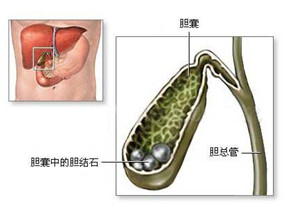 专家详解结石是怎么形成的？(图1)