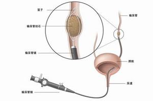四川结石病医院详解：左肾积水(图3)