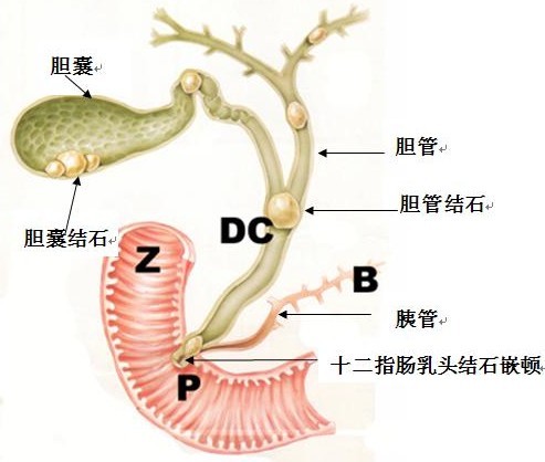 清楚认识什么是胆结石胆管切除术！(图1)