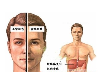 清楚认识什么是胆结石胆管切除术！(图2)