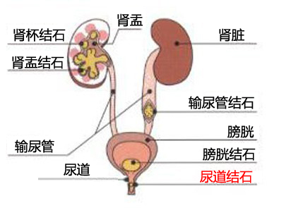 治疗膀胱结石要多少钱？(图3)