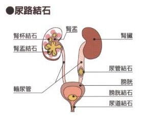 专家详谈：体外碎石术(图2)
