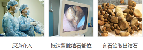 肾结石有哪些病症表现(图5)