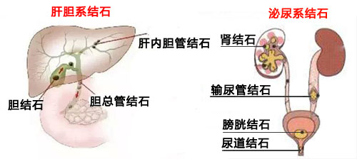 结石怎么来不重要，怎么取出才重要(图1)