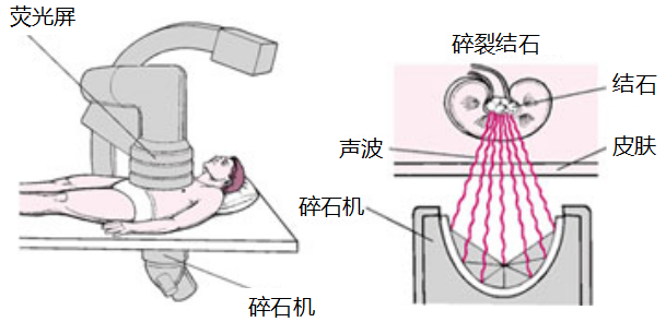 这些因素竟是导致尿结石形成的原因！(图3)