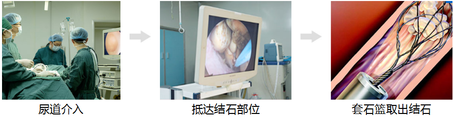 还在盲目体外碎石？这些风险不看就晚了(图4)