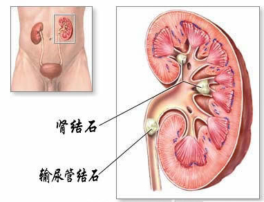 尿结石了，用体外碎石治疗合适吗？(图1)