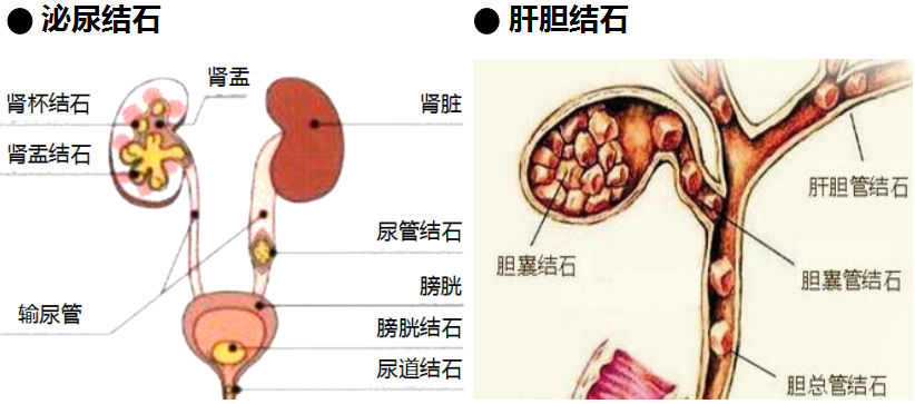 打结石需要多少钱？(图1)