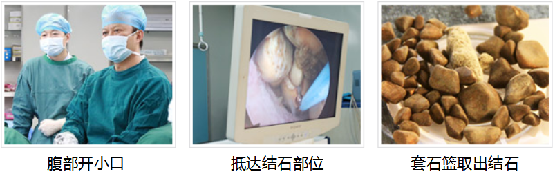 打结石需要多少钱？(图3)