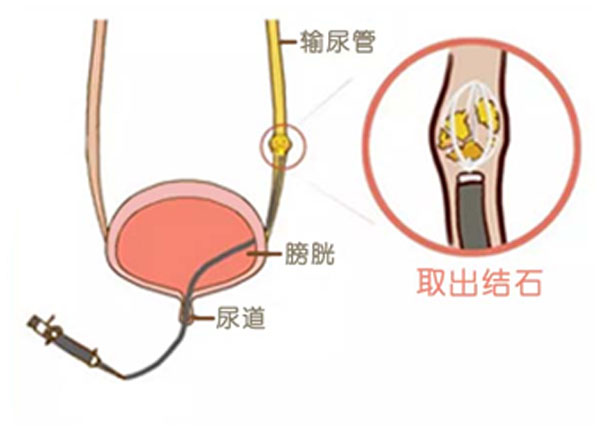 教你几招快速解决结石(图4)