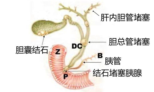 简单自测了解得结石原因(图6)