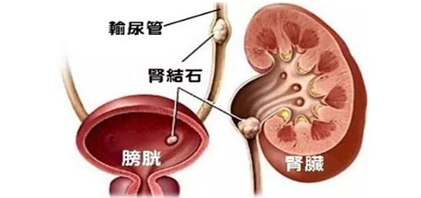简单自测了解得结石原因(图8)