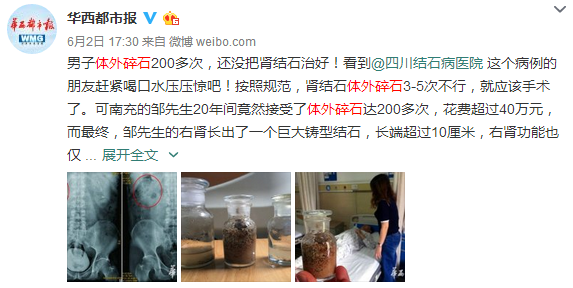 打结石想便宜又打得好？给你介绍一家好医院(图3)