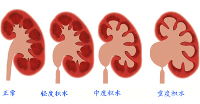 得了输尿管结石还能不能过性生活？(图3)