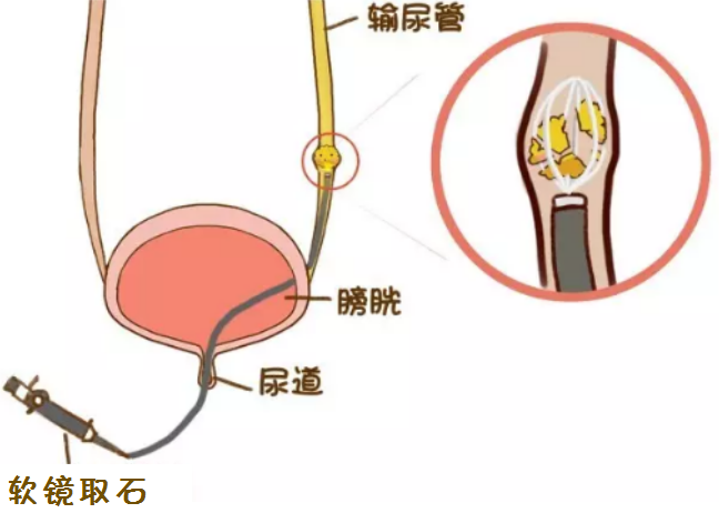 如何解决输尿管结石的呕吐症状？(图2)